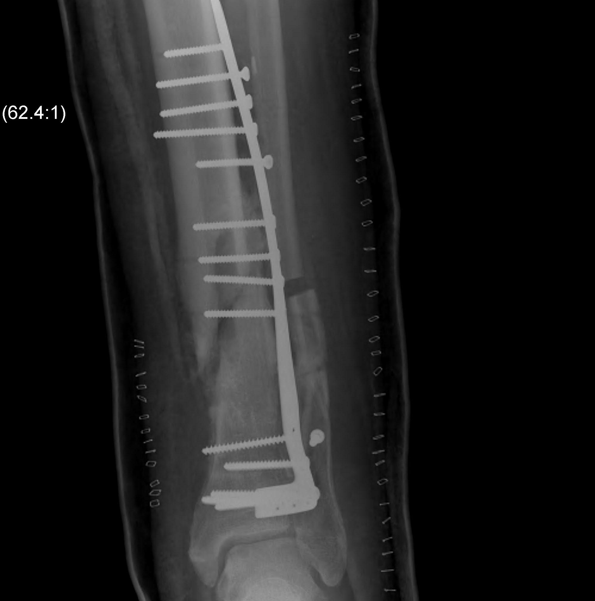 Distal Tibial ORIF Nonunion